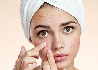 Acne Treatment in Lahore
