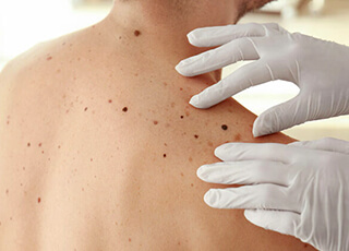 Skin Tags Removal In Lahore