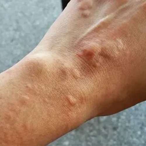 Blisters and Pustules, best eczema treatment in Lahore