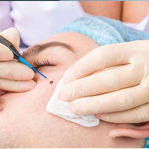 warts removal treatment in lahore, best warts removal treatment in pakistan,