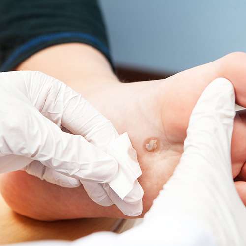 warts removal treatment in Lahore, best warts removal treatment in Pakistan,