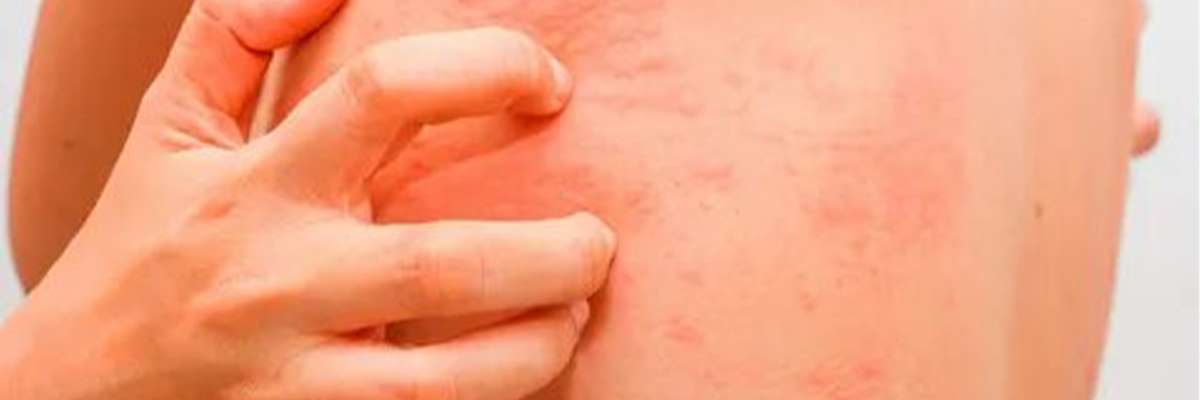 best eczema treatment in lahore main